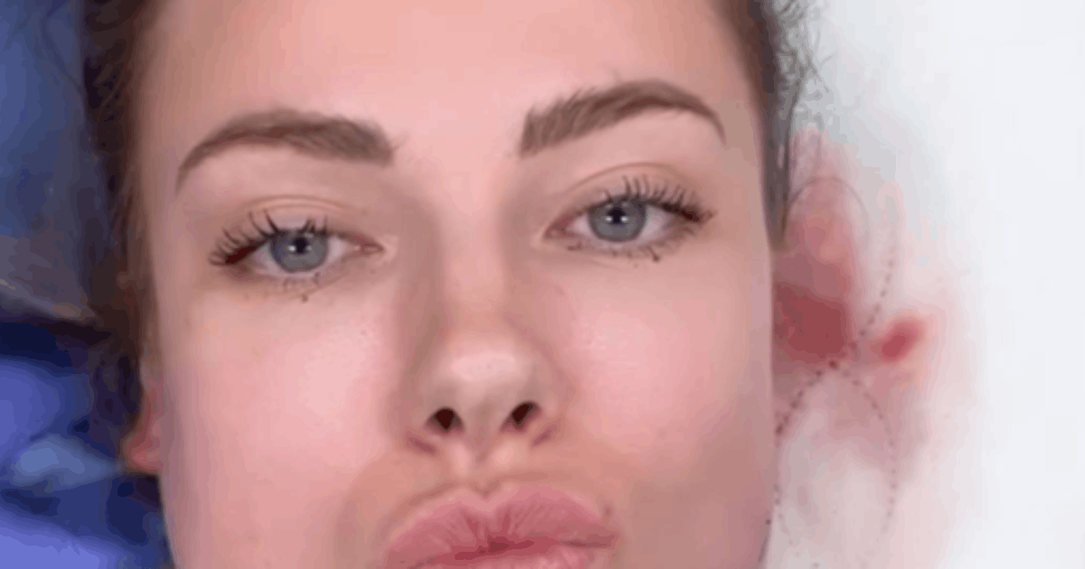 Oplas Akibat Filter Medsos