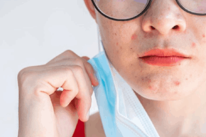 Krim Steroid Wajah Rusak