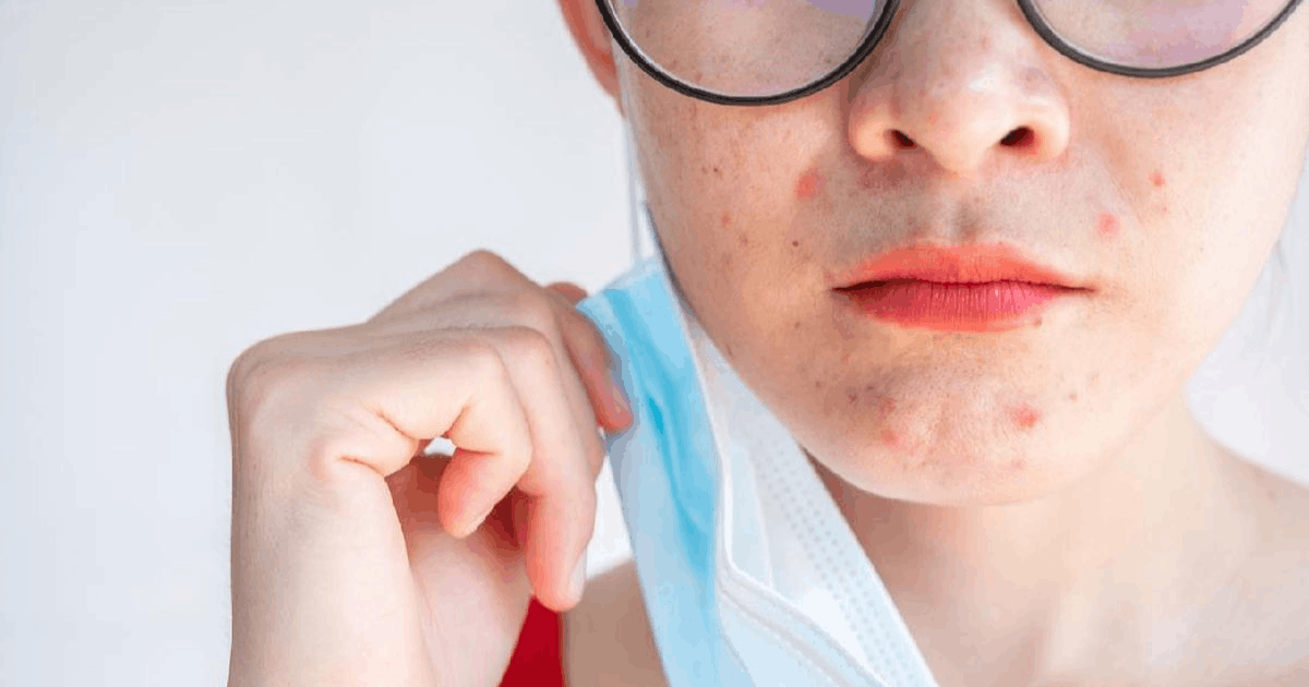 Krim Steroid Wajah Rusak