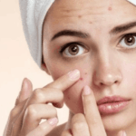 Kebiasaan Penyebab Jerawat Parah