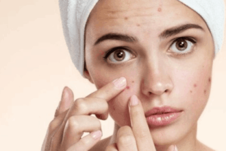 Kebiasaan Penyebab Jerawat Parah