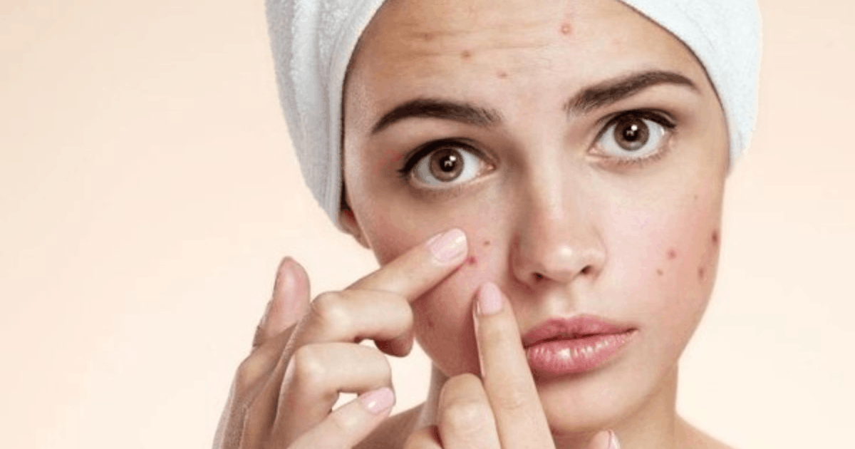 Kebiasaan Penyebab Jerawat Parah