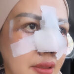 Elly Sugigi Jalani Oplas Hidung dan Mata, Segini Harganya 9 elly sugigi - ilustrasi berita Elly Sugigi Jalani Oplas Hidung dan Mata, Segini Harganya