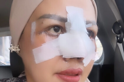 Elly Sugigi Jalani Oplas Hidung dan Mata, Segini Harganya 49 elly sugigi - ilustrasi berita Elly Sugigi Jalani Oplas Hidung dan Mata, Segini Harganya